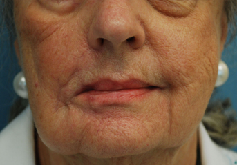 Lip Symmetry Procedure Results