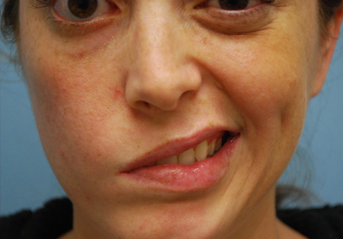 Masseter to Facial Nerve Transfers