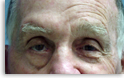 brow image after