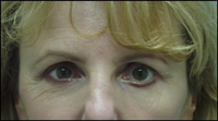 Gold Eyelid Weight Procedure - Eye Closure without External Test Weight
