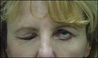 Gold weight eyelid closure restoration