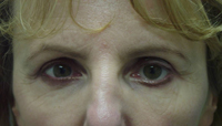 Gold Eyelid Weight Procedure - Eye Closure with External Test Weight