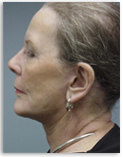 results of neck lift refinement procedure