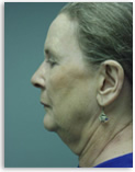 neck lift refinement procedure before surgery