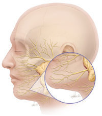 Myectomy