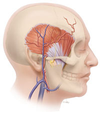 Temporalis Muscle Transfer