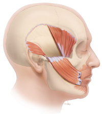 Temporalis Muscle procedure for facial paralysis