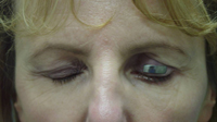 gold weight eyelid procedure Houston TX