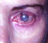 Keratitis, Gold Weight Eyelift Procedure