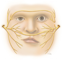 Cross face nerve graft