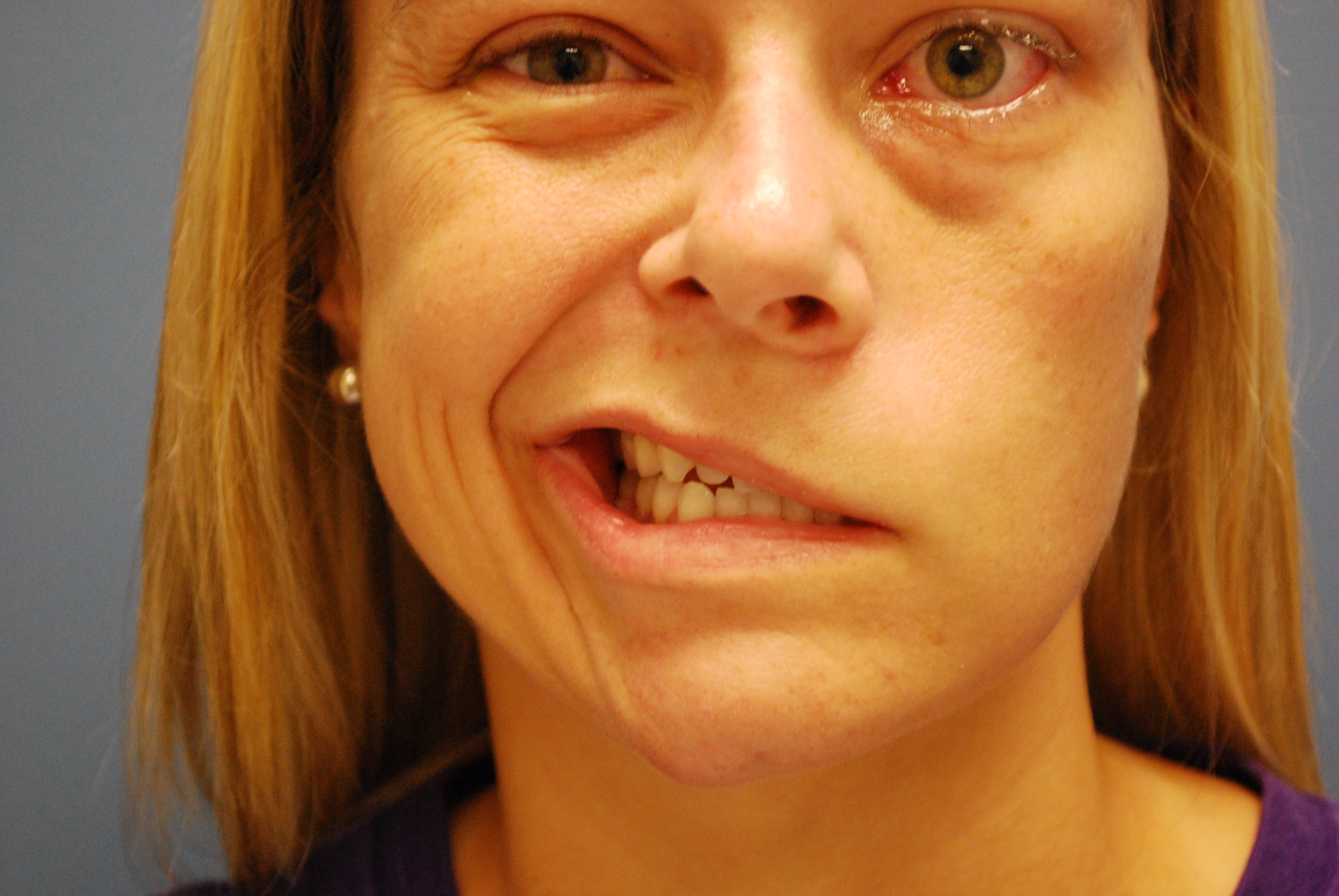 Loss of Smile closure due to facial nerve paralysis